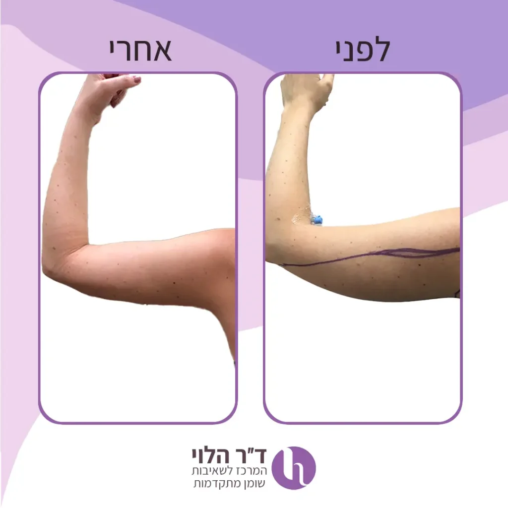 לפני ואחרי שאיבת שומן בזרועות