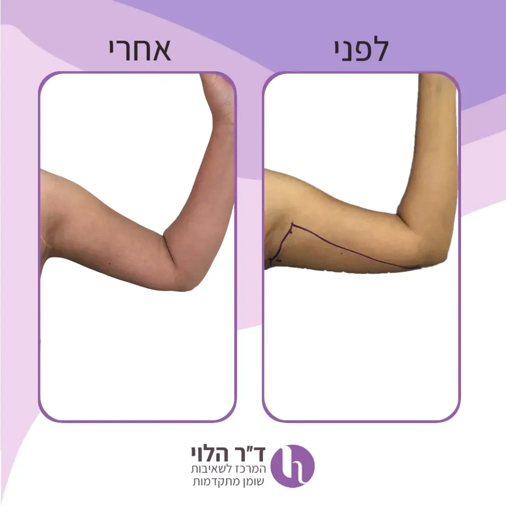 שאיבת שומן בזרועות לפני ואחרי