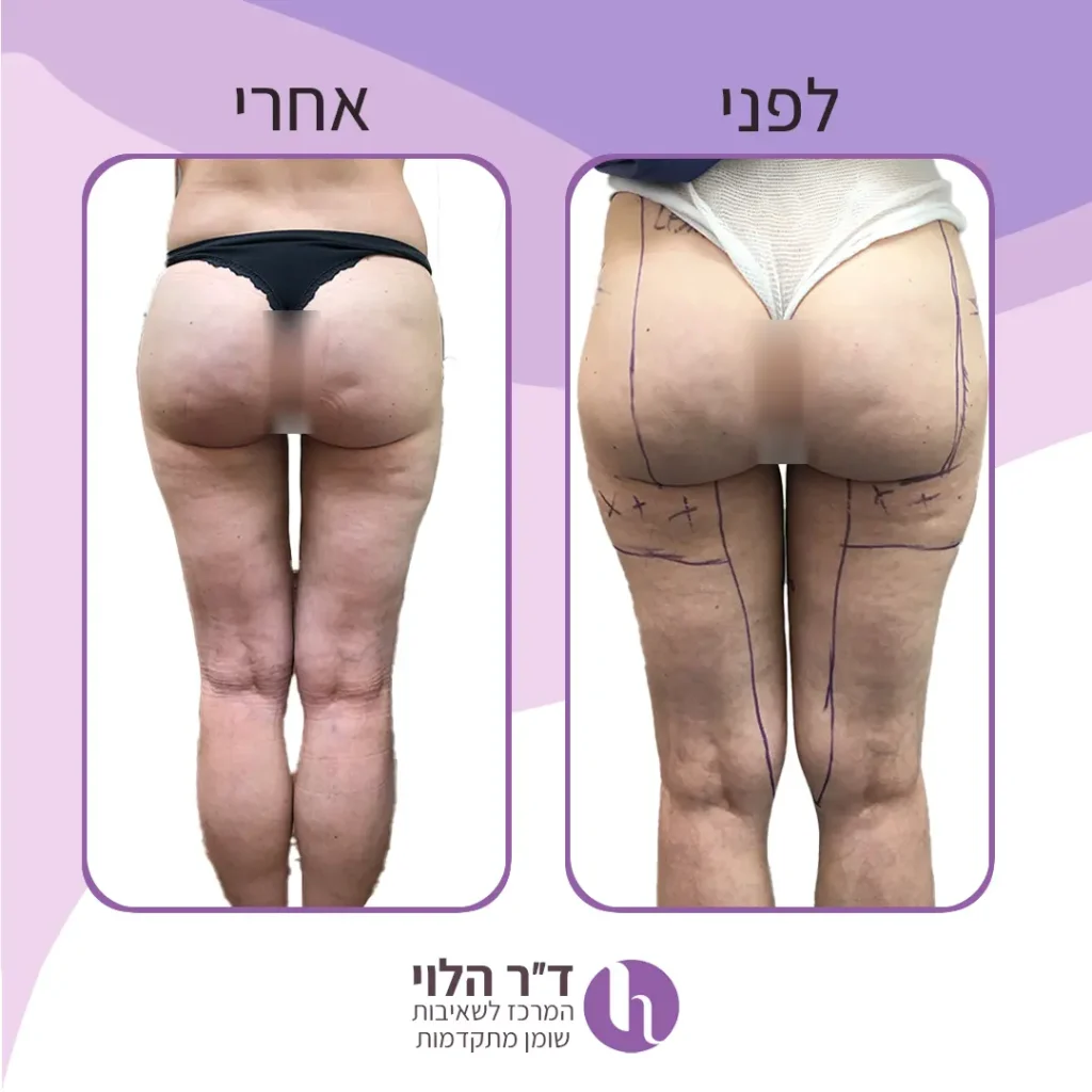 שאיבת שומן בירכיים חיצוניות ופנימיות