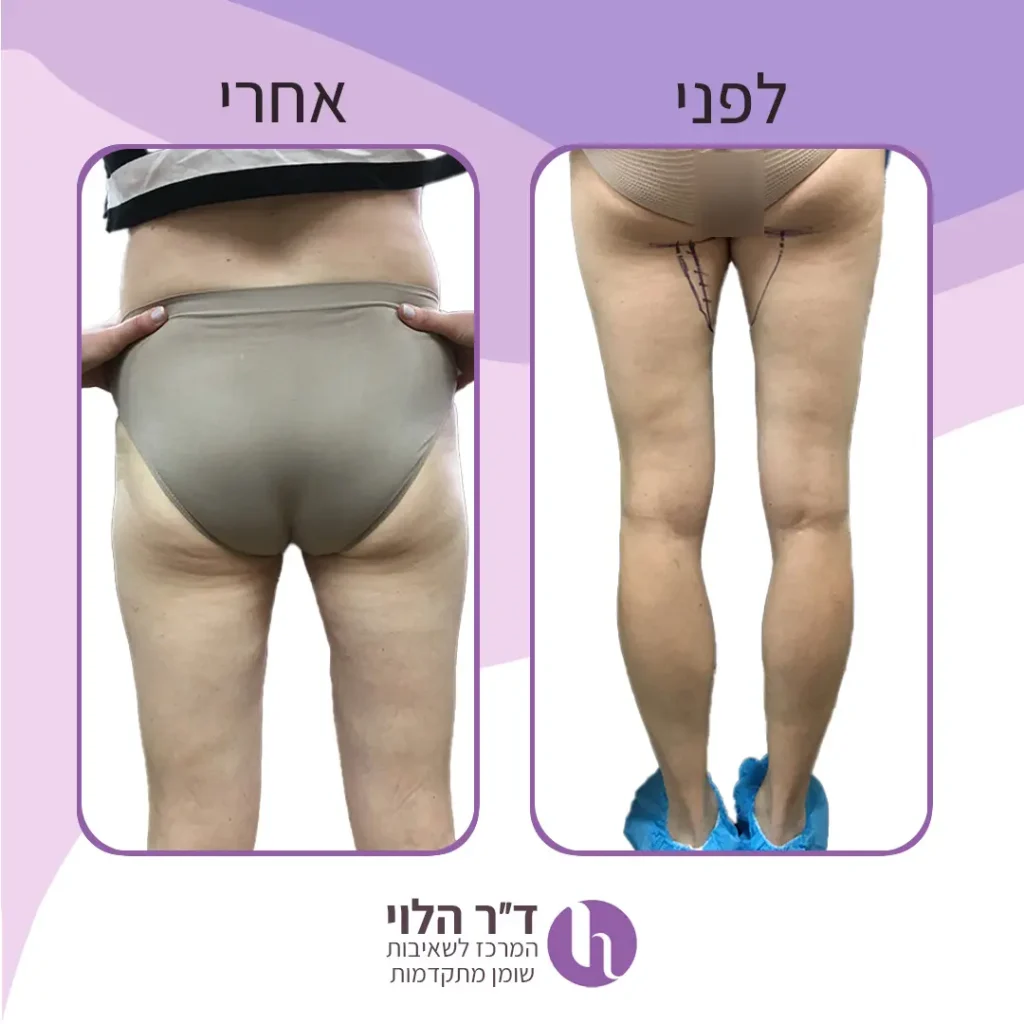 שאיבת שומן בירכיים לפני ואחרי