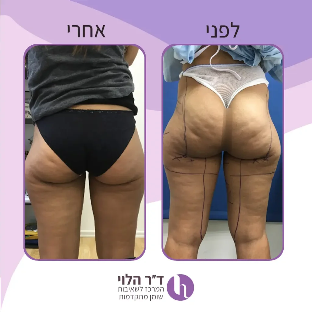 לפני ואחרי שאיבת שומן